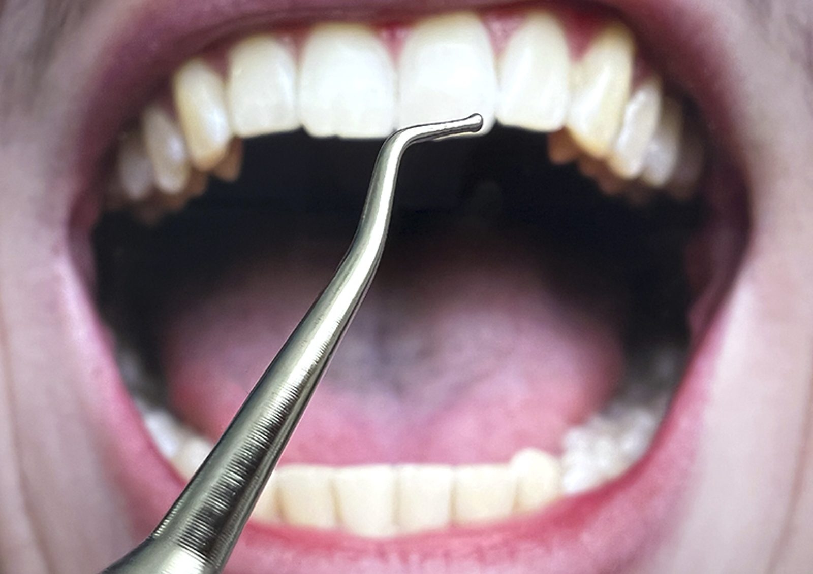 Стоматологи рассказали, чем опасны пломбы с маркетплейсов